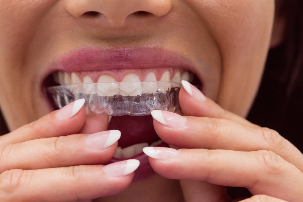 כמה עולה invisalign